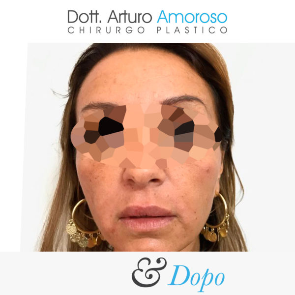 Lifting viso - Dott. Arturo Amoroso