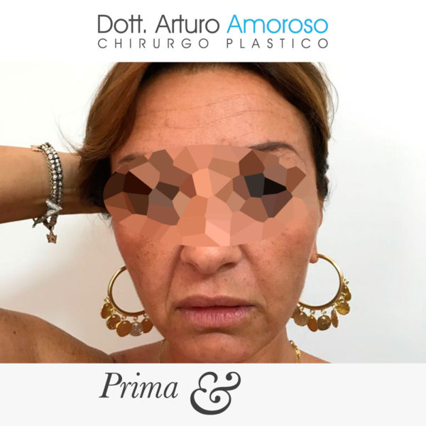 Lifting viso - Dott. Arturo Amoroso