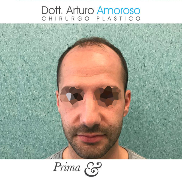Autotrapianto di capelli con tecnica FUE. Dott. Arturo Amoroso. I prima e dopo