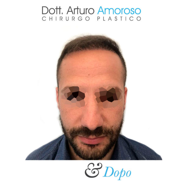 Autotrapianto di capelli con tecnica FUE. Dott. Arturo Amoroso. I prima e dopo