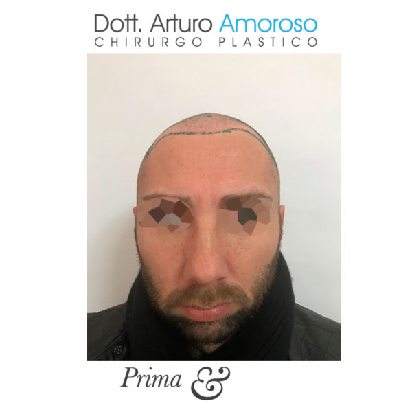 Autotrapianto di capelli con tecnica FUE. Dott. Arturo Amoroso. I prima e dopo