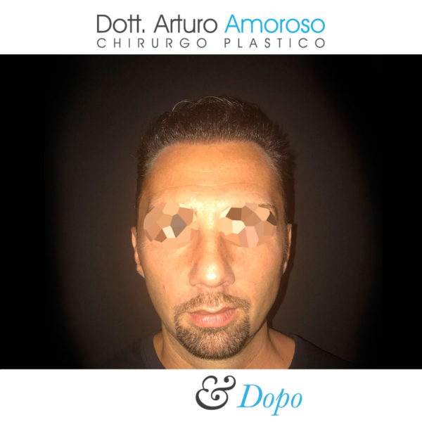 Autotrapianto di capelli con tecnica FUE. Dott. Arturo Amoroso. I prima e dopo