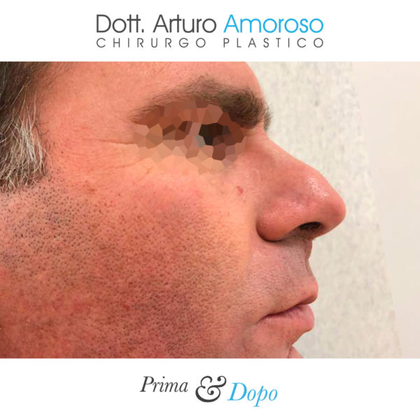 Rinoplastica. Prima e dopo. Dott. Arturo Amoroso