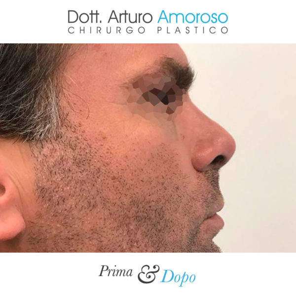 Rinoplastica. Prima e dopo. Dott. Arturo Amoroso