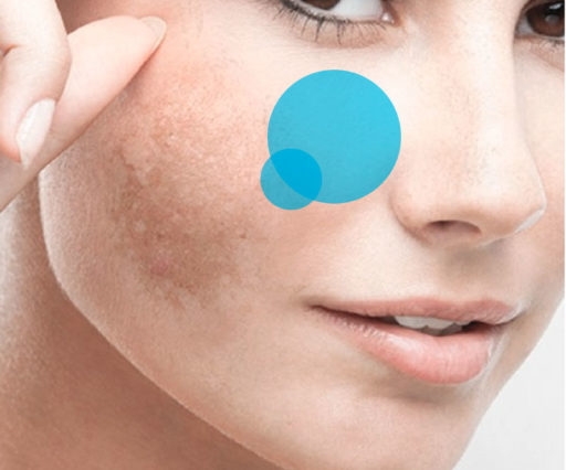 Eliminare le macchie cutanee chirurgicamente