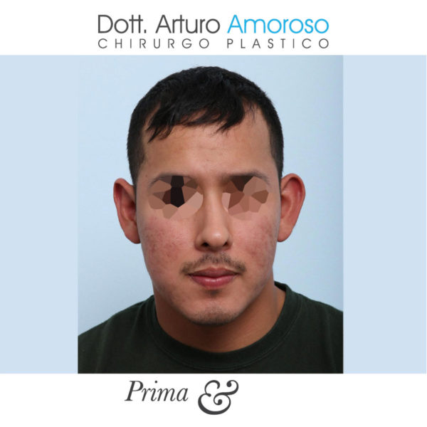 Otoplastica, orecchie a sventola Dott. Arturo Amoroso
