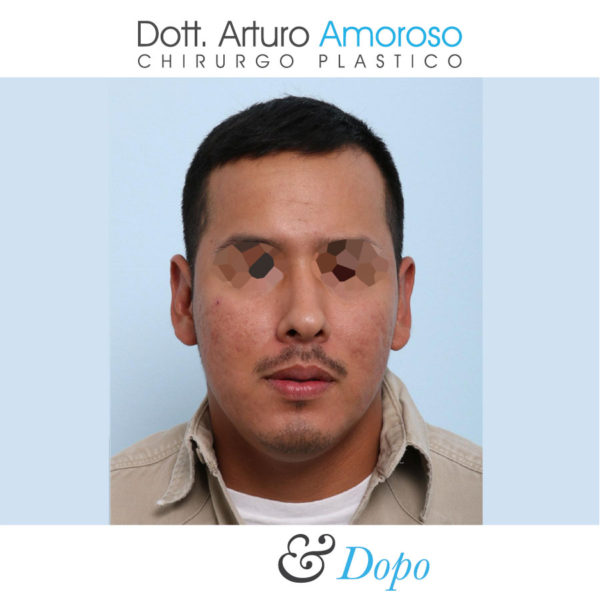 Otoplastica, orecchie a sventola Dott. Arturo Amoroso