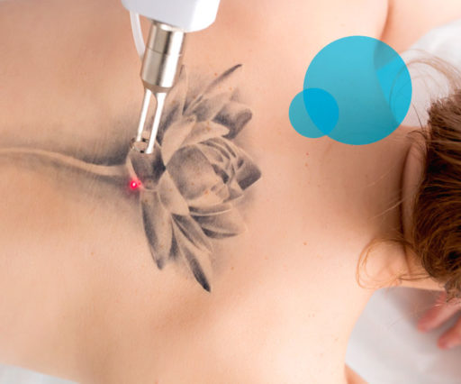 Rimozione tatuaggi Laser. Dott. Arturo Amoroso