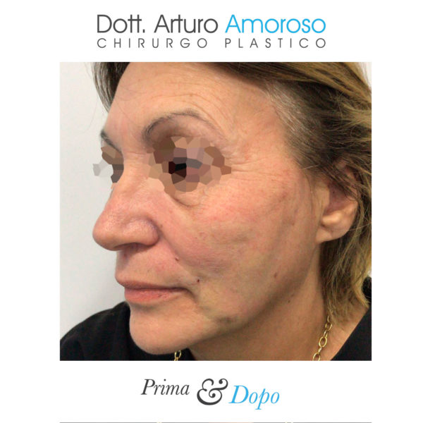 Interventi Viso medicina estetica. Dott. Arturo Amoroso