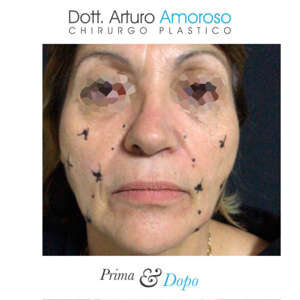 Interventi Viso medicina estetica. Dott. Arturo Amoroso