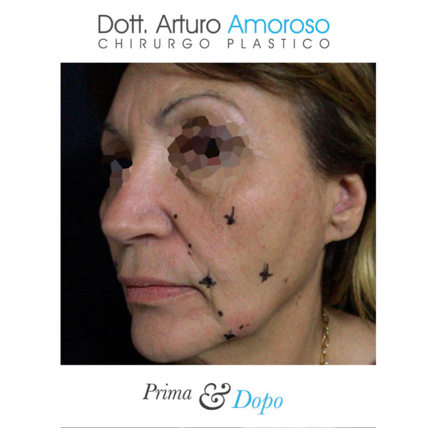 Interventi Viso medicina estetica. Dott. Arturo Amoroso