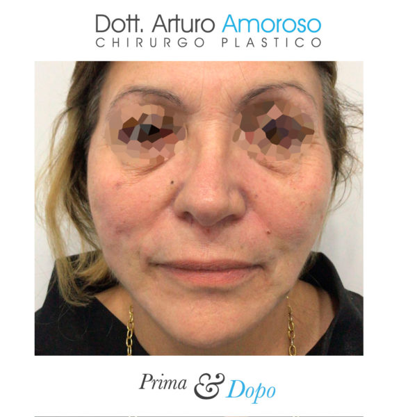 Interventi Viso medicina estetica. Dott. Arturo Amoroso