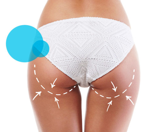 Rimodellamento Glutei Arturo Amoroso Chirurgo Plastico