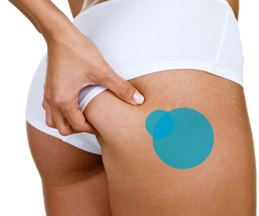 Rimozione smagliature