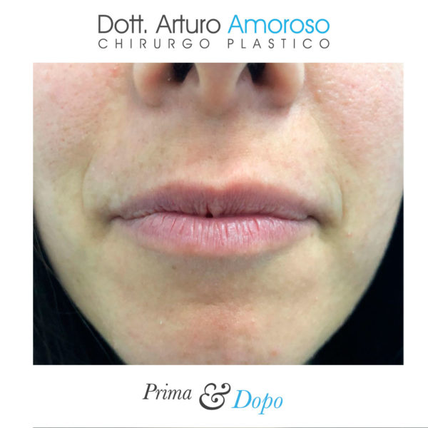 Prima e dopo Aumento labbra filler. Dott. Arturo Amoroso