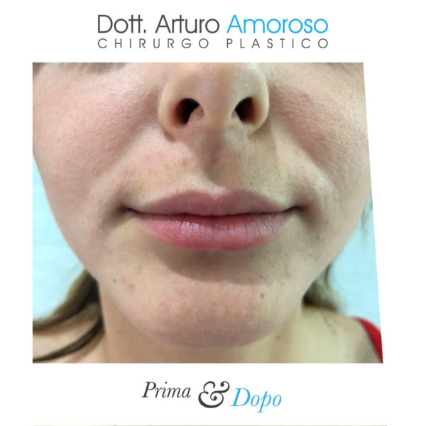 Prima e dopo Aumento labbra filler. Dott. Arturo Amoroso