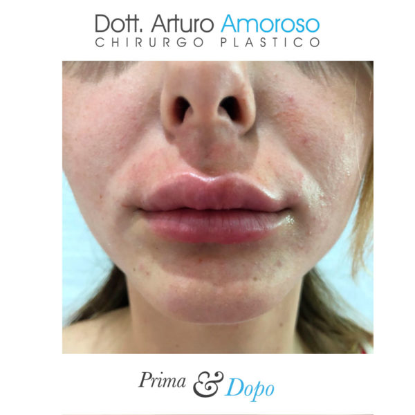 Prima e dopo Aumento labbra filler. Dott. Arturo Amoroso