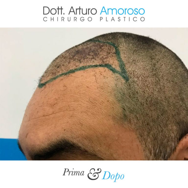 Prima e dopo Trapianto di capelli con tecnica FUE. Dott. Arturo Amoroso