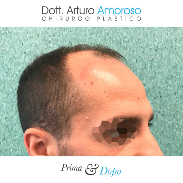 Prima e dopo Trapianto di capelli con tecnica FUE. Dott. Arturo Amoroso