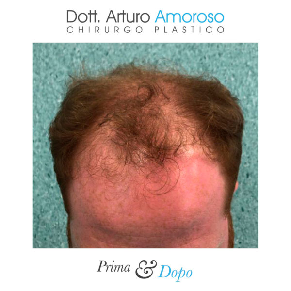 Prima e dopo Trapianto di capelli con tecnica FUE. Dott. Arturo Amoroso