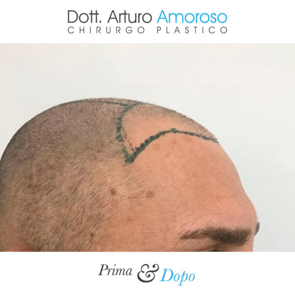 Prima e dopo Trapianto di capelli con tecnica FUE. Dott. Arturo Amoroso