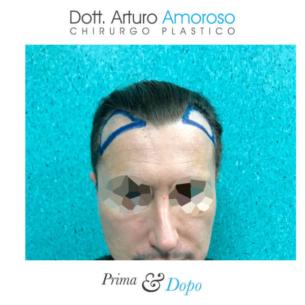 Prima e dopo Trapianto di capelli con tecnica FUE. Dott. Arturo Amoroso