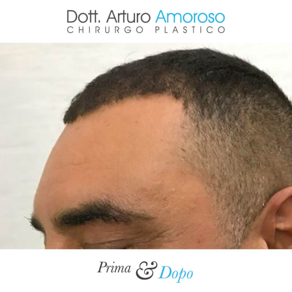 Prima e dopo Trapianto di capelli con tecnica FUE. Dott. Arturo Amoroso