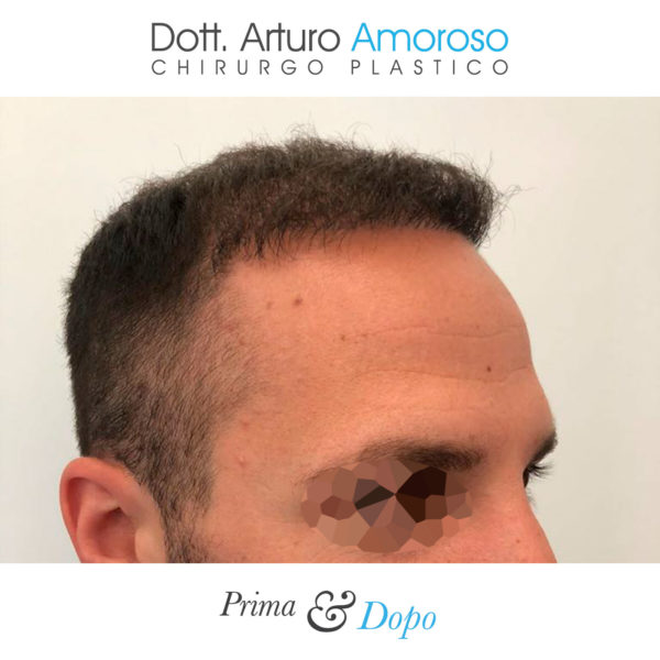 Prima e dopo Trapianto di capelli con tecnica FUE. Dott. Arturo Amoroso