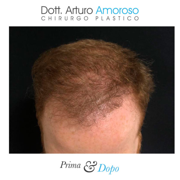 Prima e dopo Trapianto di capelli con tecnica FUE. Dott. Arturo Amoroso