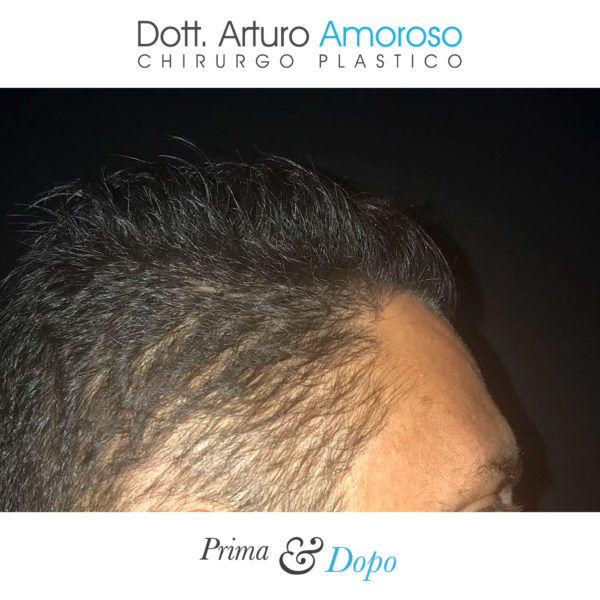 Prima e dopo Trapianto di capelli con tecnica FUE. Dott. Arturo Amoroso