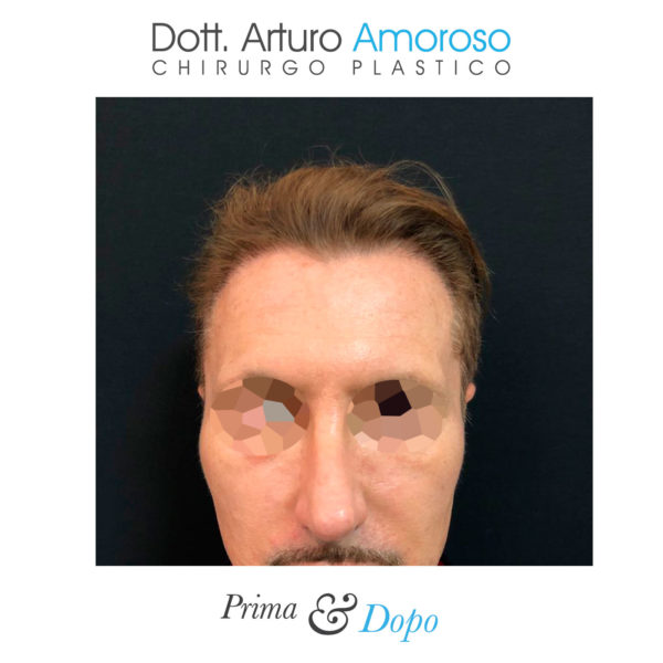 Prima e dopo Trapianto di capelli con tecnica FUE. Dott. Arturo Amoroso