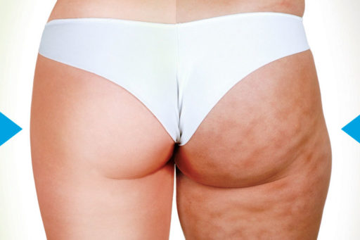 Lipoemulsione sottocutanea, cos’è e come si effettua