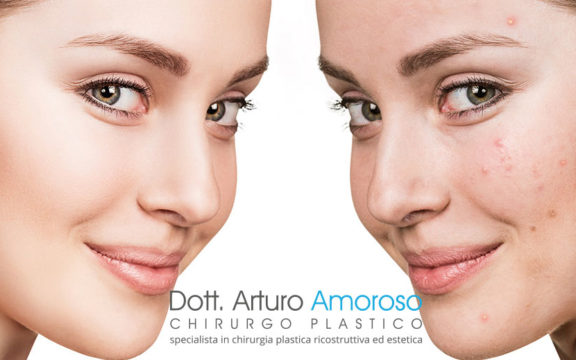 Trattamento laser per acne