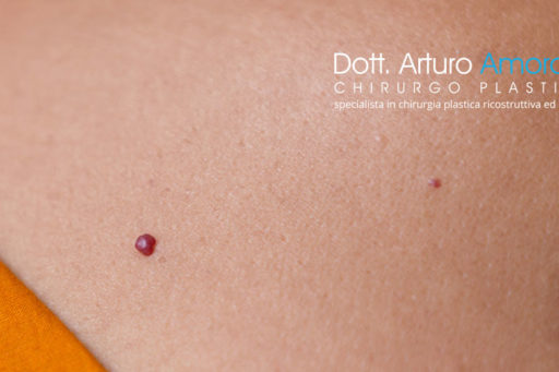 Laserterapia selettiva per angiomi