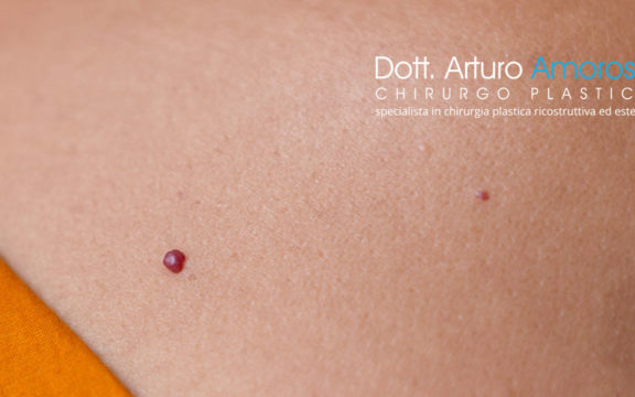 Laserterapia selettiva per angiomi