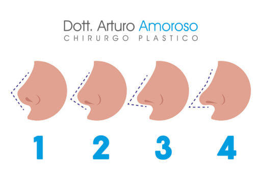 Rinofiller: la tecnica per rimodellare il proprio naso