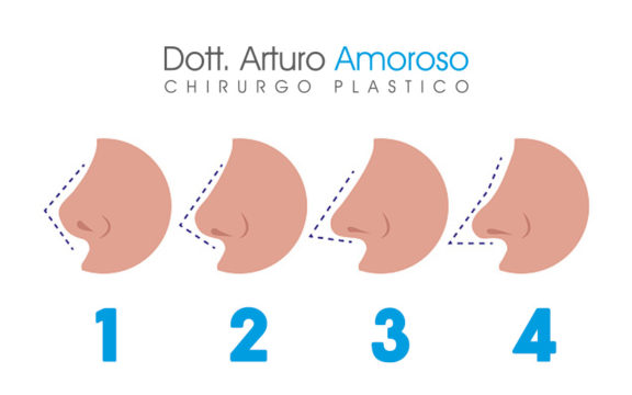 Rinofiller: la tecnica per rimodellare il proprio naso