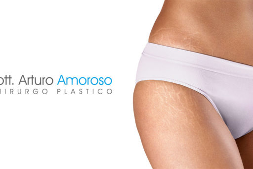 Eliminare le smagliature bianche: si puo?