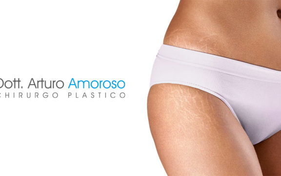 Eliminare le smagliature bianche: si puo?