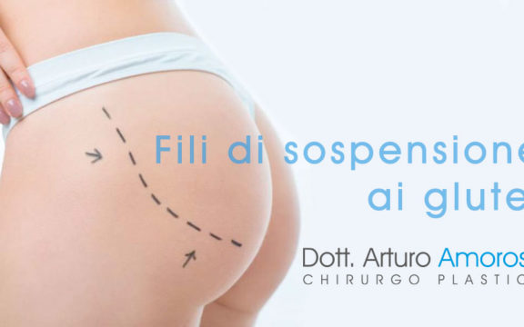 Fili di sospensione glutei:cosa sono?