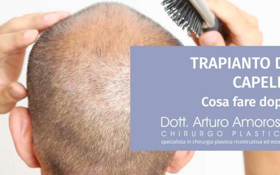 Cosa fare dopo il trapianto di capelli