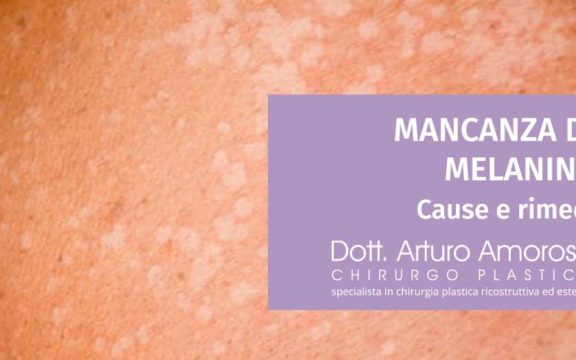 Mancanza di melanina: cause e rimedi