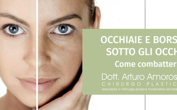 Come combattere le occhiaie