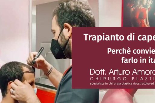 Perché conviene fare il trapianto di capelli in Italia