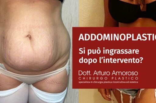 Dopo addominoplastica si ingrassa?