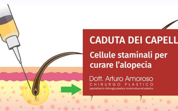 Cellule staminali per capelli per curare l’alopecia