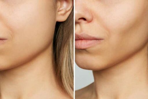 Bolla di Bichat intervento e costi