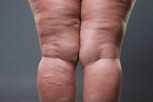 Lipedema gambe trattamento e cause