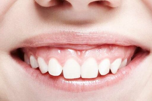 Sorriso Gengivale: correzione con il filler