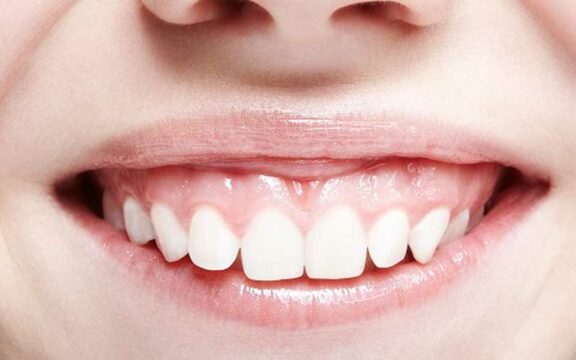 Sorriso Gengivale: correzione con il filler